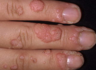 Народные средства от бородавок