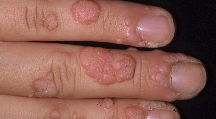 Народные средства от бородавок