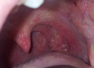 Папилломы во рту