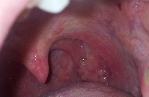 Папилломы во рту