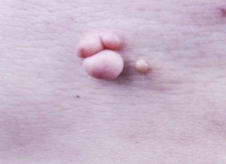 Какой врач поможет с лечением папиллом?