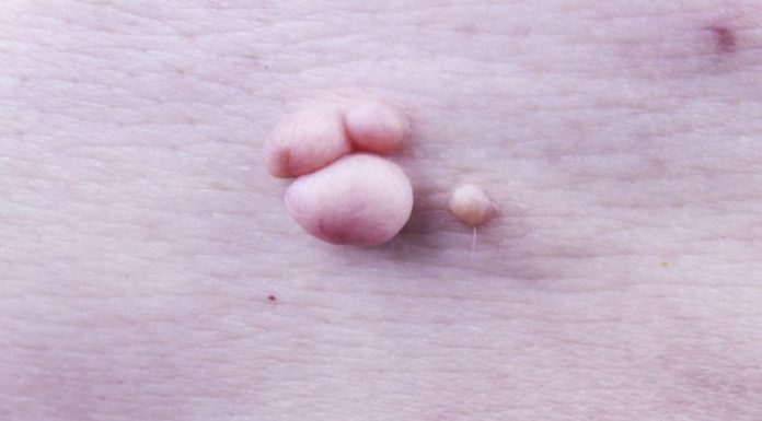 Какой врач поможет с лечением папиллом?