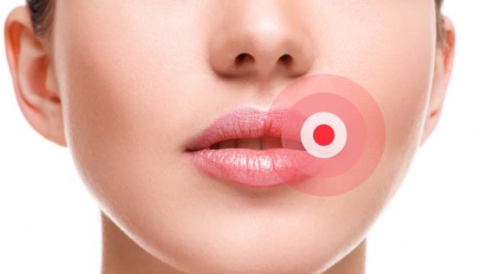 Пластырь от герпеса на губах