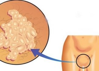 Папилломы во влагалище (вагинальные)