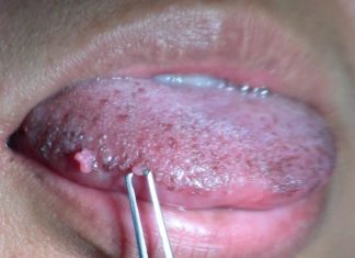 Отзывы о лечении папилломатоза