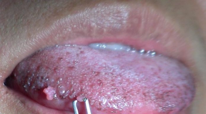 Отзывы о лечении папилломатоза