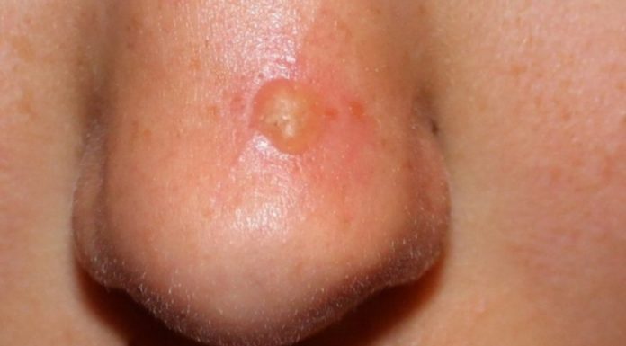 Бородавка на носу