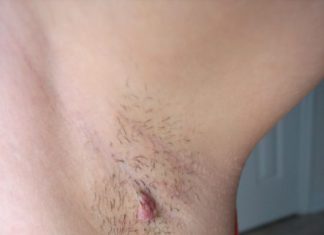 Висячие папилломы