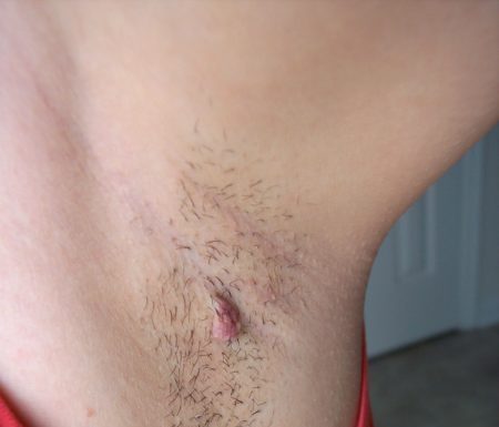 Висячие папилломы