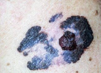 Если на родинке выросла папиллома