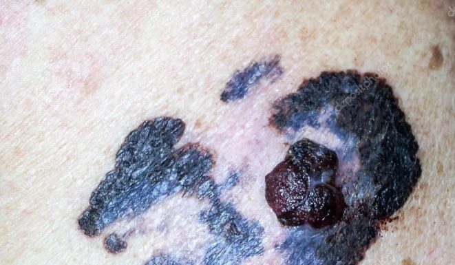 Если на родинке выросла папиллома