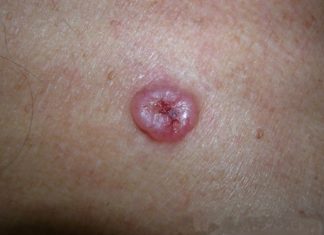 Наросты на коже похожие на бородавки