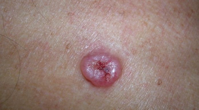 Наросты на коже похожие на бородавки