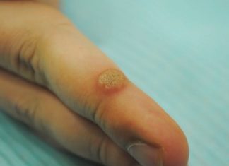 Лечение бородавок Оксолиновой мазью