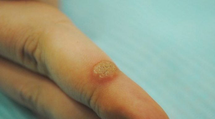 Лечение бородавок Оксолиновой мазью