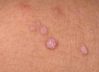 Особенности локализации папиллом в паховой области