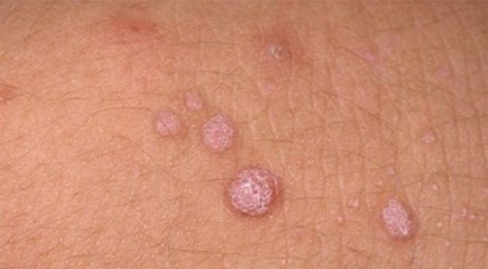 Особенности локализации папиллом в паховой области