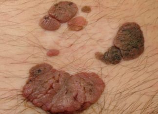 Папилломы на члене, головке, мошонке у мужчин