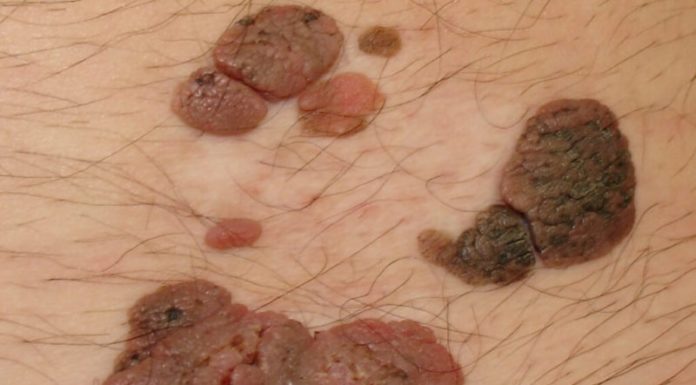 Папилломы на члене, головке, мошонке у мужчин