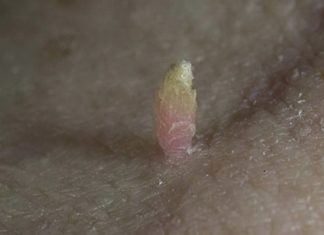 Нитевидная папиллома: симптоматика и лечение