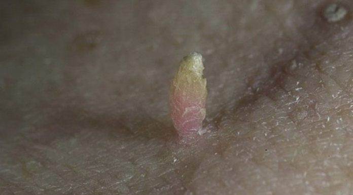 Нитевидная папиллома: симптоматика и лечение