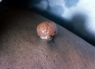 Базальноклеточные папилломы