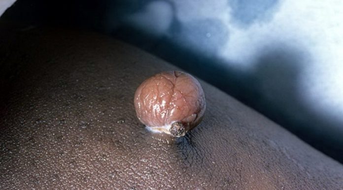 Базальноклеточные папилломы