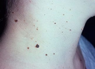 Лечение бородавок на шее