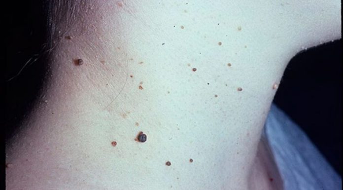 Лечение бородавок на шее