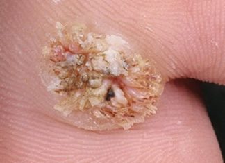 Как вылечить бородавку в домашних условиях