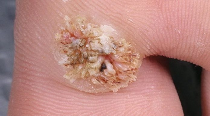 Как вылечить бородавку в домашних условиях