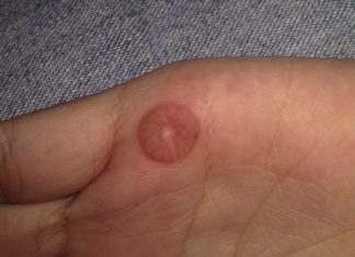 Хирургическое удаление бородавок