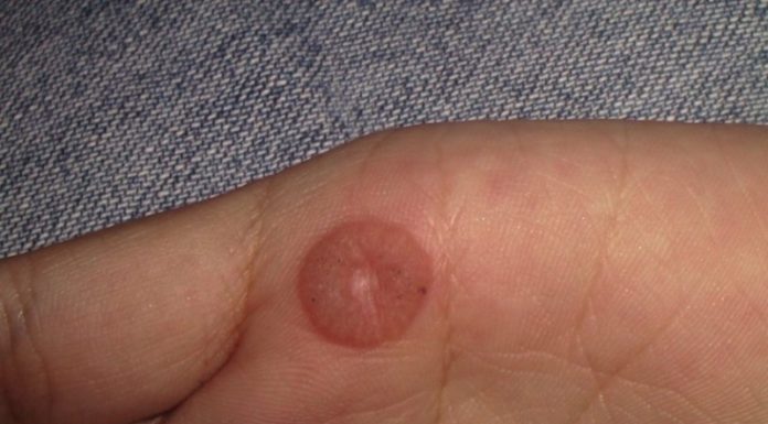 Хирургическое удаление бородавок