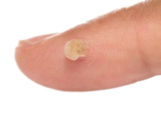 Препарат “Сани Скин” от папиллом