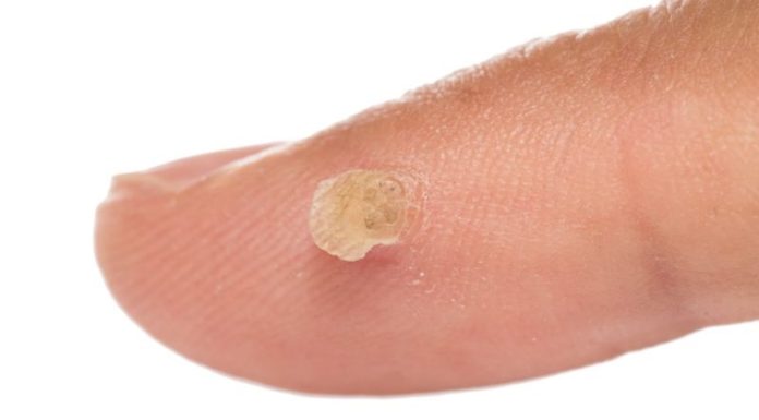 Препарат “Сани Скин” от папиллом