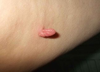 Бородавки под мышками