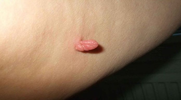 Бородавки под мышками