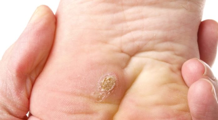 Удаляем подошвенные бородавки дома