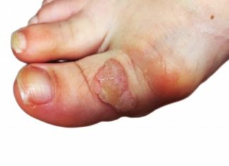 Откуда берутся бородавки на пальце ноги