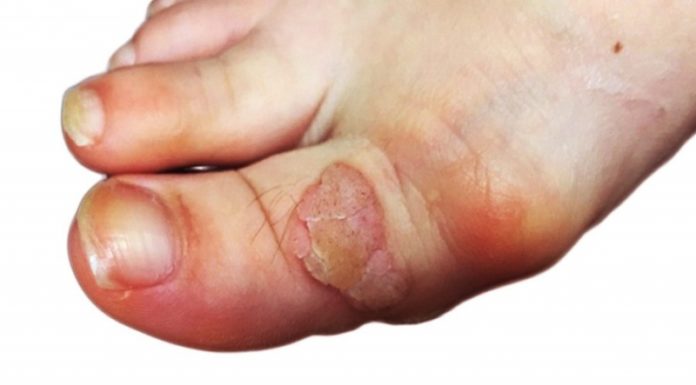Откуда берутся бородавки на пальце ноги