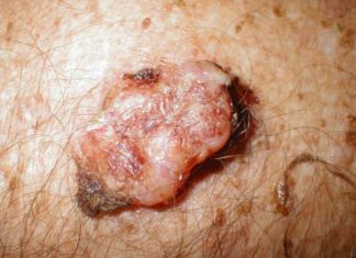 Как передаются бородавки