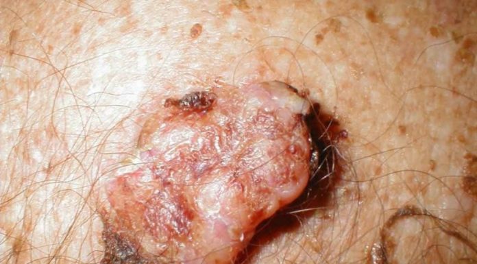 Как передаются бородавки