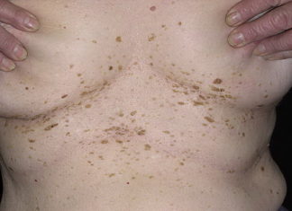 Локализация папиллом в области груди