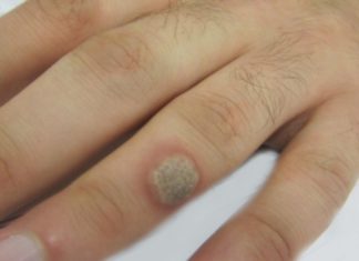 Как правильно удалить бородавки на пальце