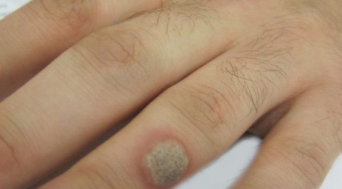 Как правильно удалить бородавки на пальце