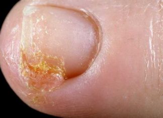 Подкожные бородавки