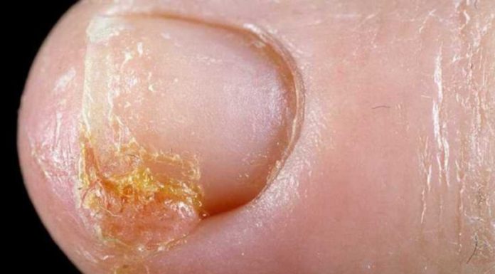 Подкожные бородавки