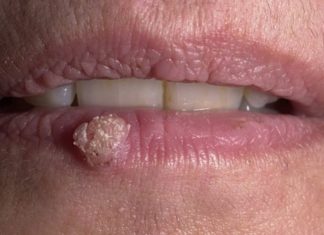 Бородавка на губе