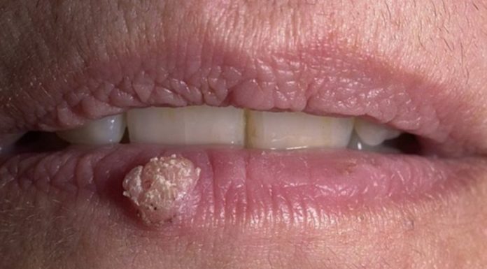 Бородавка на губе