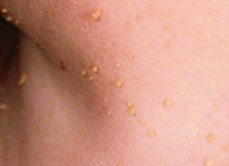 Папилломы под мышками